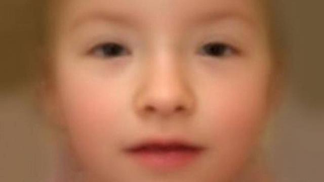 Rostro de un niño con síndrome TRAF7 generado por ordenador para ayudar a reconocer la enfermedad (Genetics in Medicine).