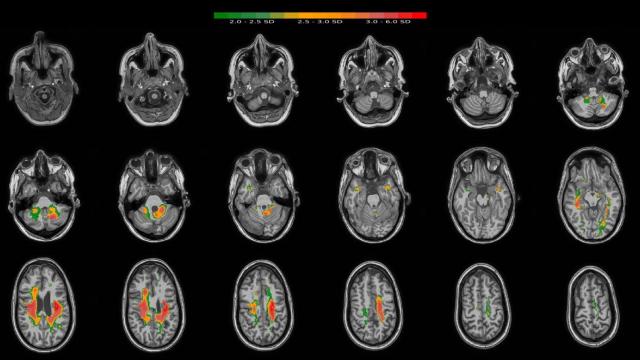 Uno de los ejemplos de detección de anomalías en el cerebro de esta startup coruñesa