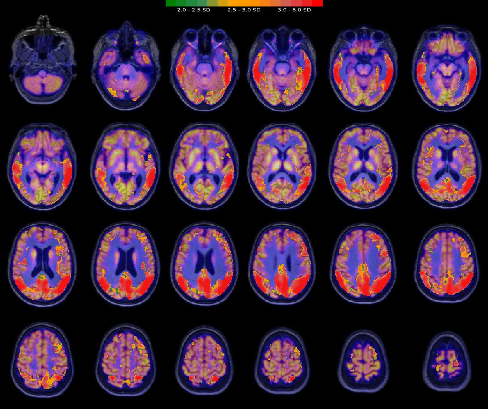 Imagen 1. Localización de zonas anormales en la imagen PET de un paciente de Alzheimer