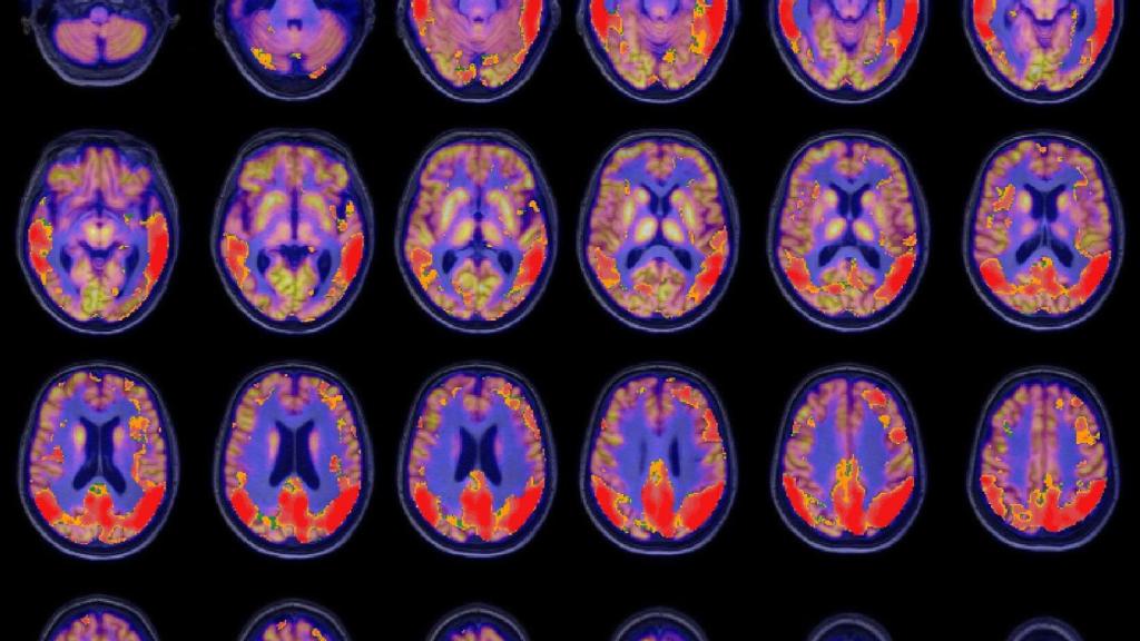 Localización de zonas anormales en la imagen PET de un paciente de Alzheimer