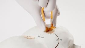 La catalana NEOS Surgery sella la hernia discal casi sin tocar