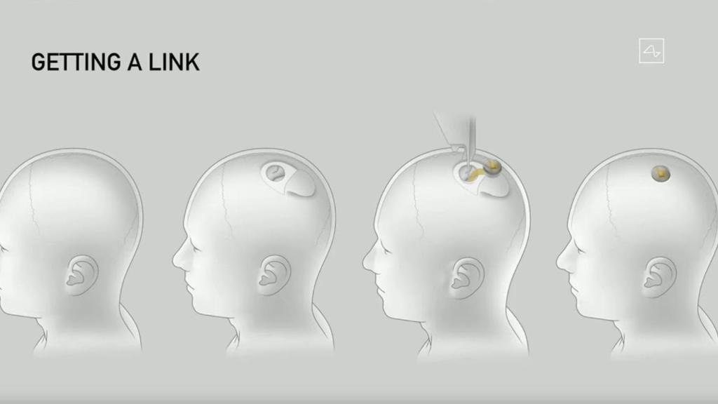 La operación de implantación de Neuralink