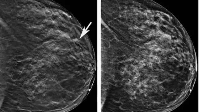 Imagen de una mamografia.