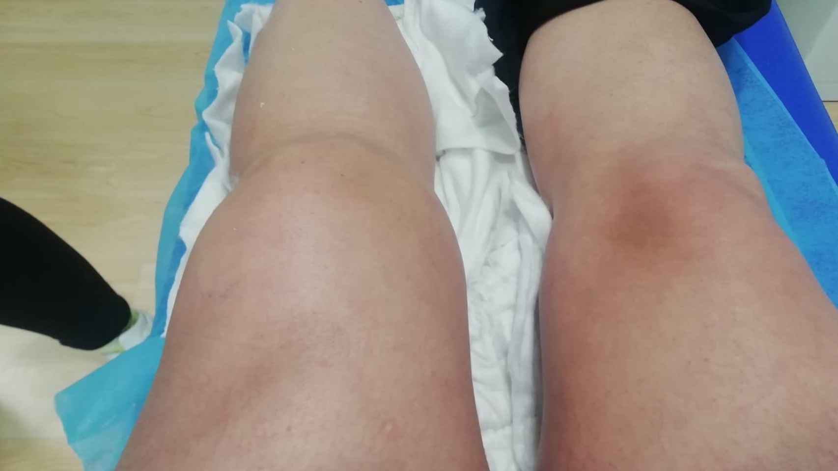 Los médicos del Hospital San Cecilio de Granada aguardaron varios meses para operar a la paciente porque tenía la rodilla inflamada.