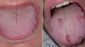 Las imágenes de la lengua de dos pacientes.