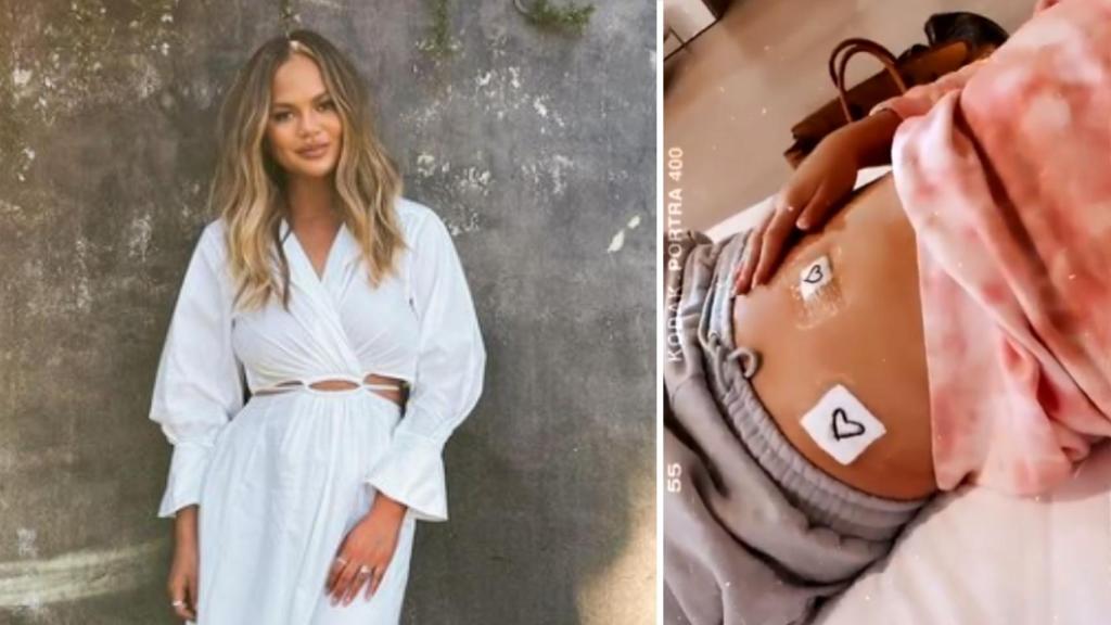 La modelo, Chrissy Teigen, y una imagen de su tripa que subió a las redes sociales tras la operación.