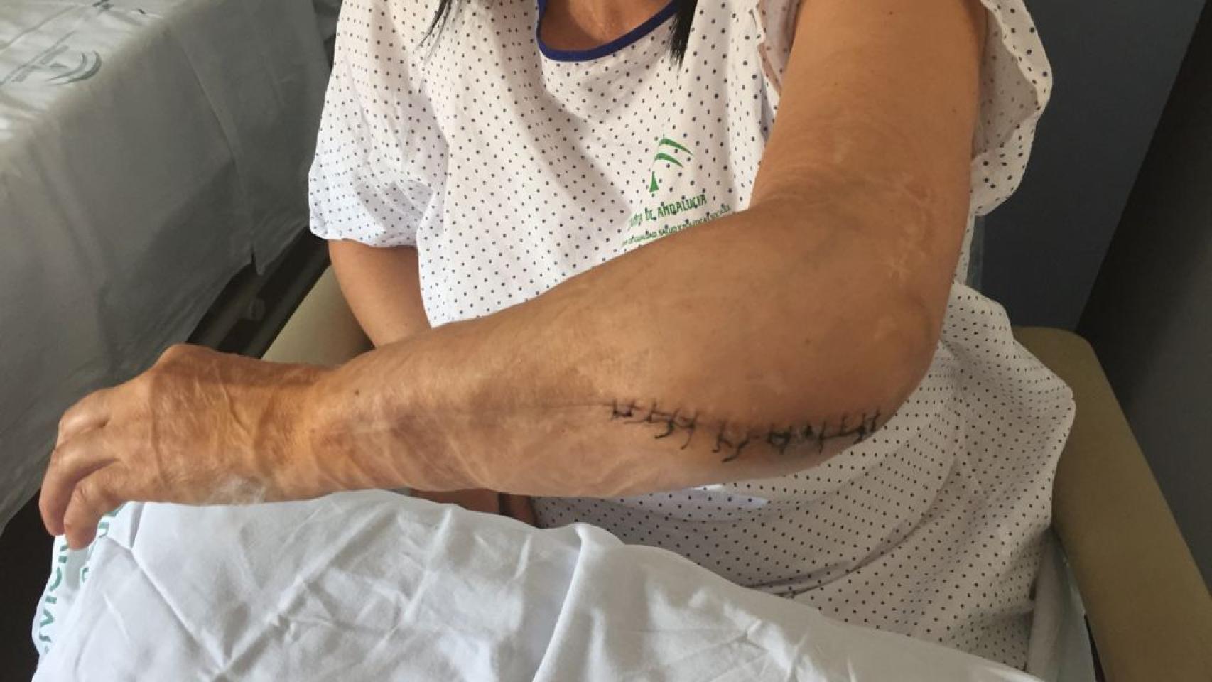 Carmen mostrando los injertos de piel y las secuelas en su brazo izquierdo tras uno de sus ingresos hospitalarios.