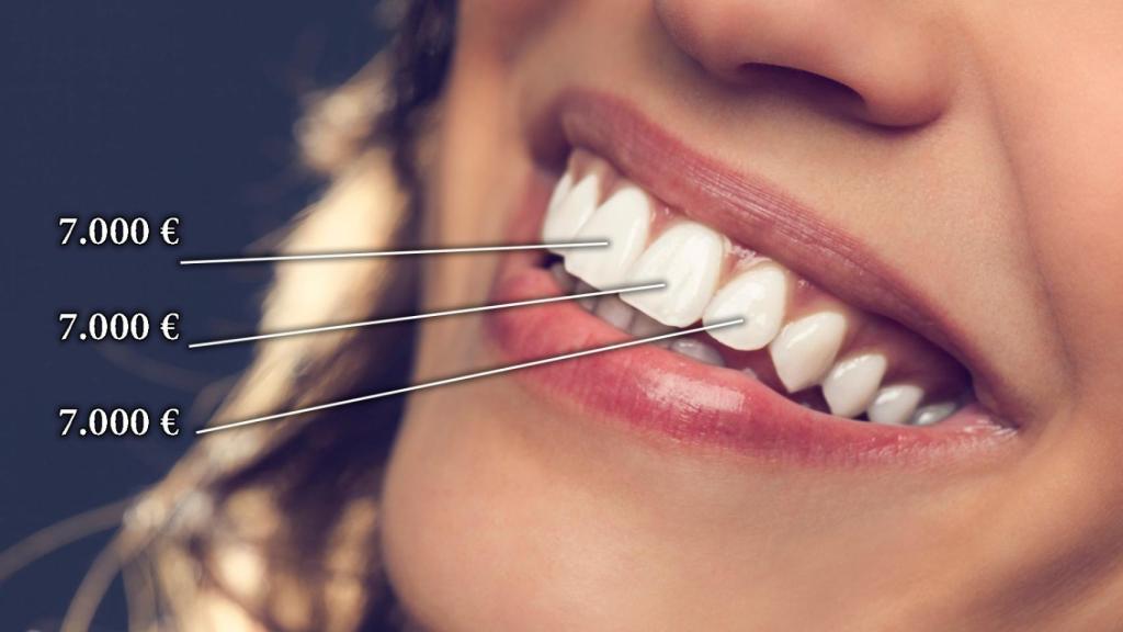 7.000 € por diente perdido: la indemnización de Dental Company a una mujer tras un implante