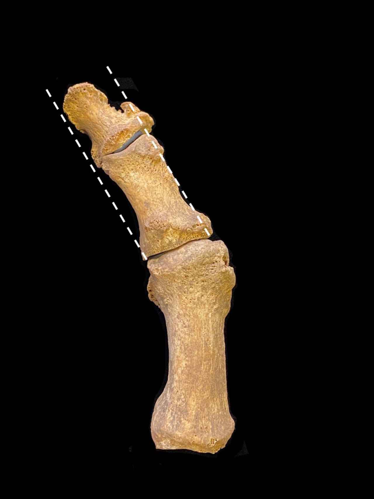 Uno de los huesos que presentaban un juanete.