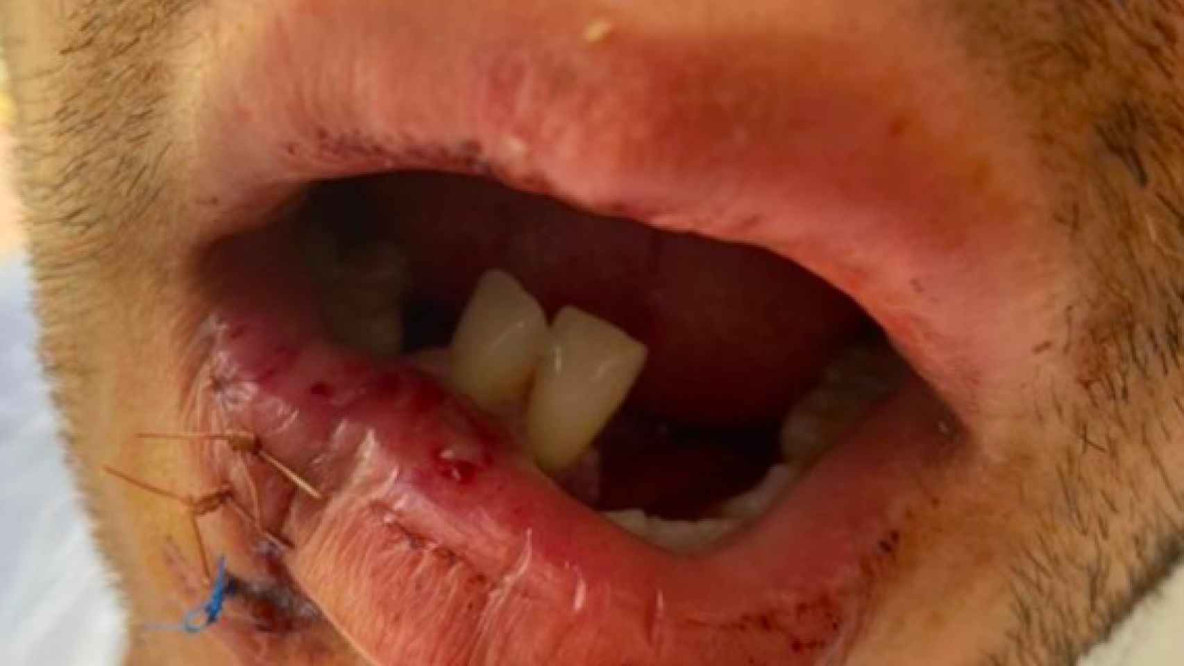 Así qudó la boca del joven agredido en el Somorrostro: fractura de mandíbula y 4 meses de baja