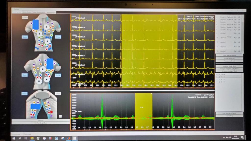 Acorys® llega a todas las regiones cardiacas de forma simultánea, sin necesidad de cirugías ni de lentos mapeos punto a punto.