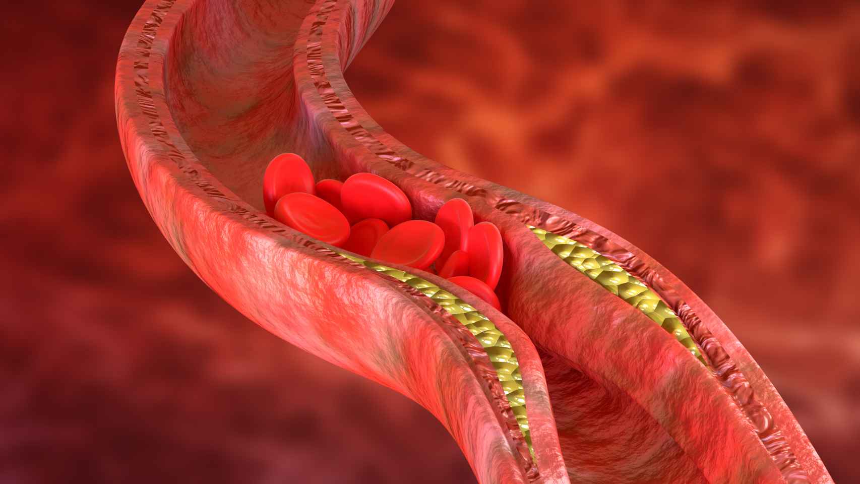 Placas de grasa en las paredes de las arterias.