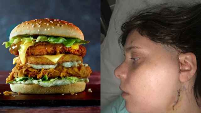 Fotomontaje de Strevens mostrando su cicatriz y una hamburguesa similar a la que inició sus problemas mandibulares.