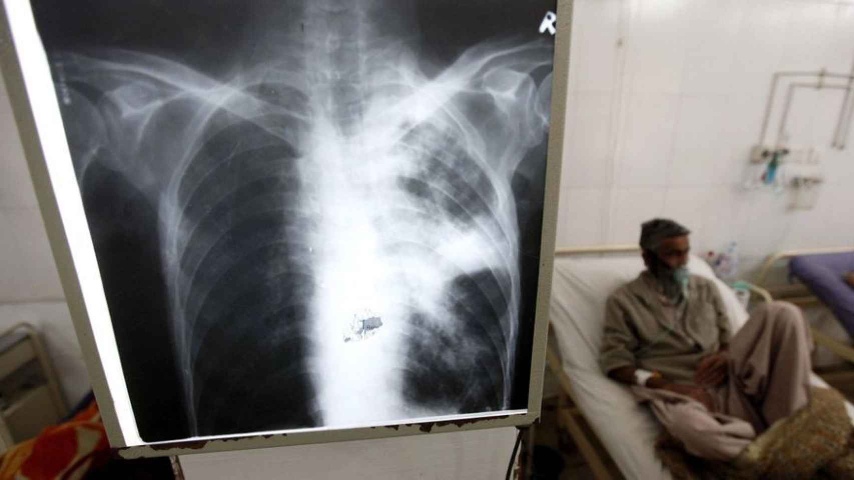 Una radiografía de los pulmones con un enfermo de tuberculosis detrás.