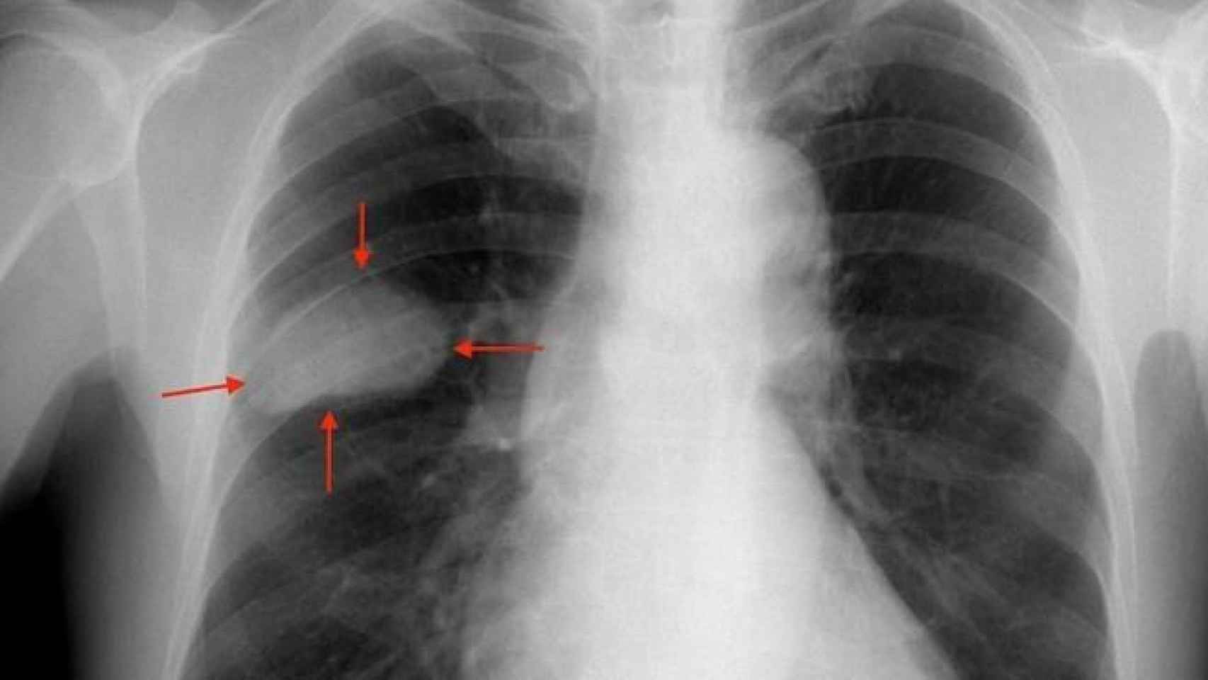 Imagen de archivo de un tumor en el pulmón.