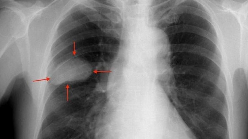 Una radiografía de los pulmones de un paciente con un tumor.