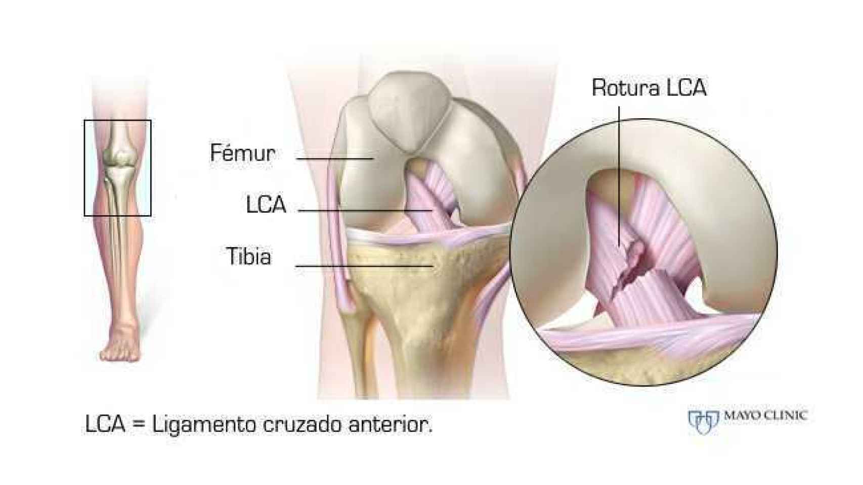 Anatomía del ligamento cruzado anterior