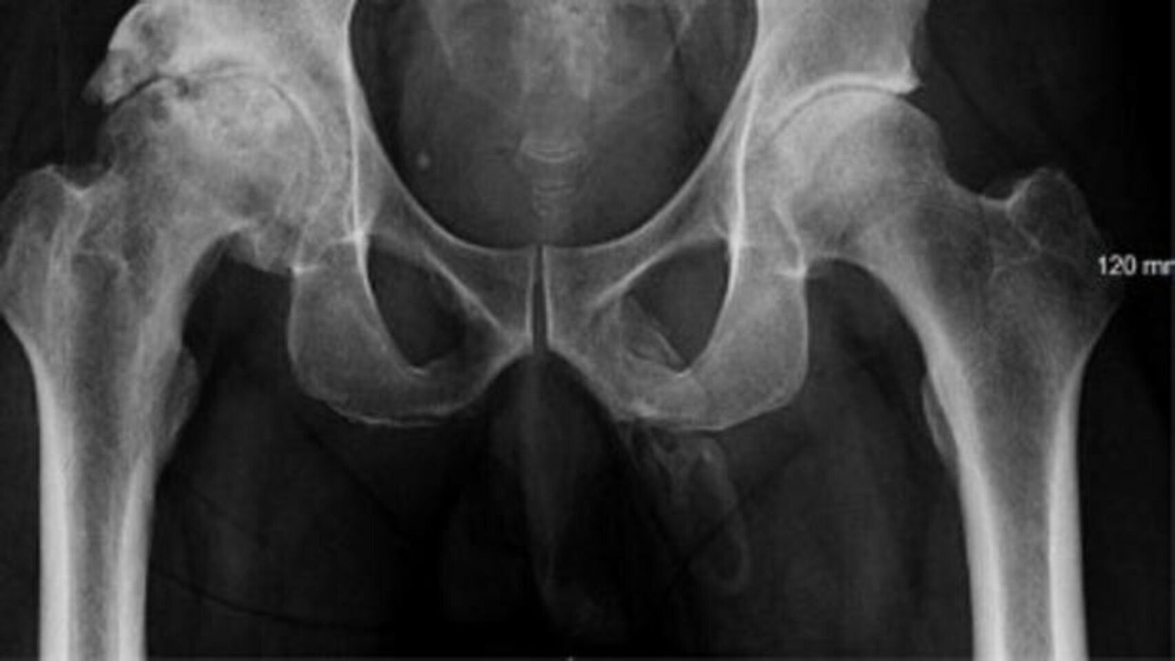 Radiografía de una cadera.