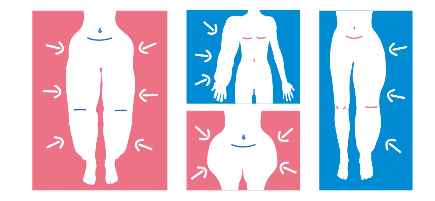 Zonas donde se acumula la grasa en personas con lipedema (en rosa) o linfodema (en azul).