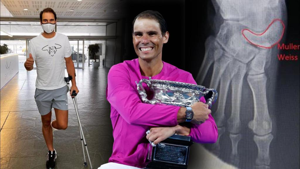 Cómo venció Rafa Nadal a la enfermedad de Muller-weiss: la explicación a una curación “inexplicable”