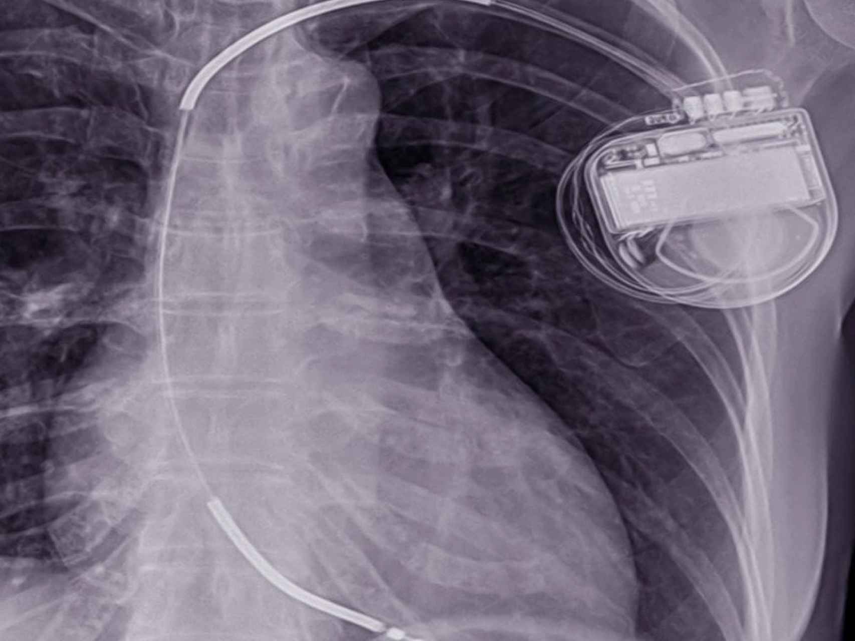 Un DAI (desfibrilador automático implantable) en una radiografía