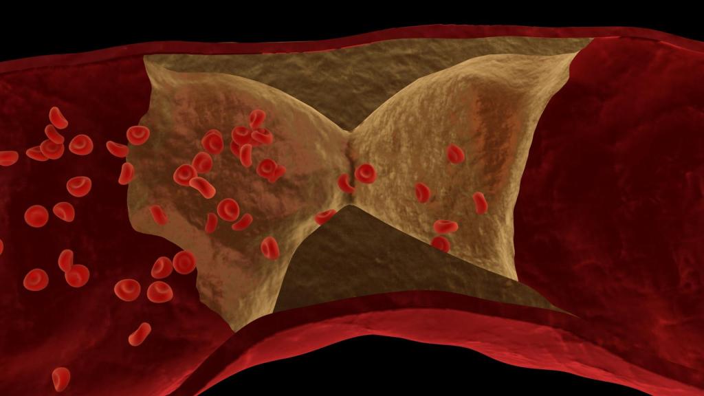 Arterias obstruídas por depósitos de grasas.