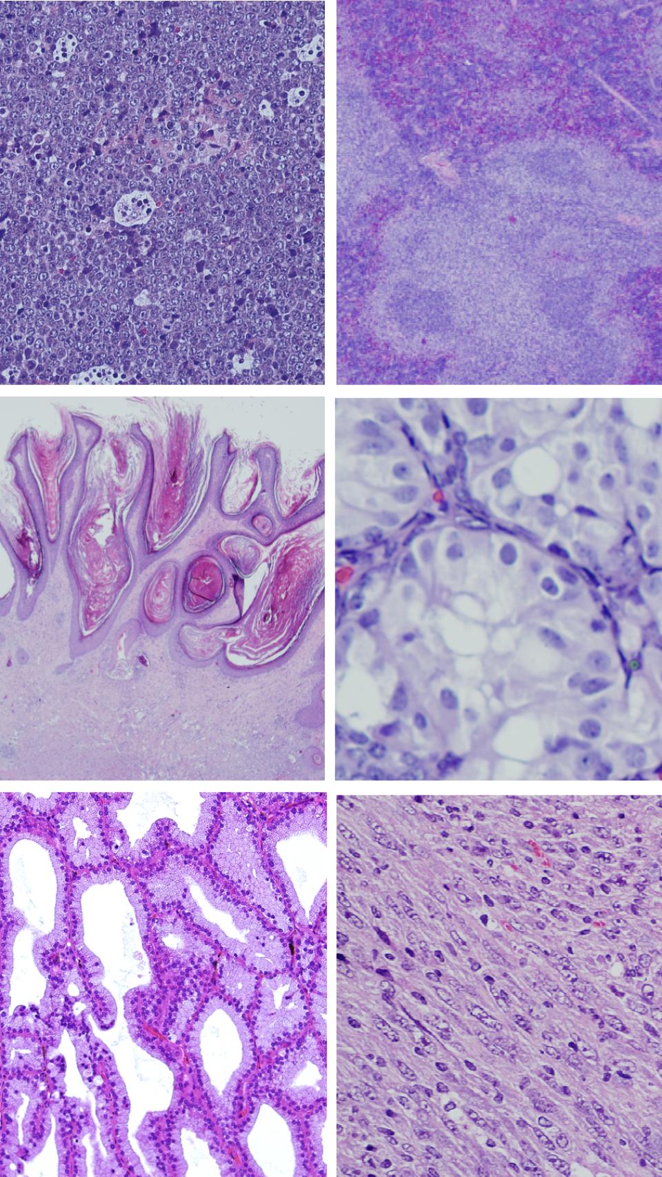 Ejemplos de los tumores inducidos tras la expresión de la versión mutante de RRAS2