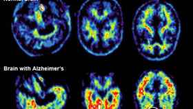 Imágenes de la resonancia magnética de un enfermo de alzhéimer.