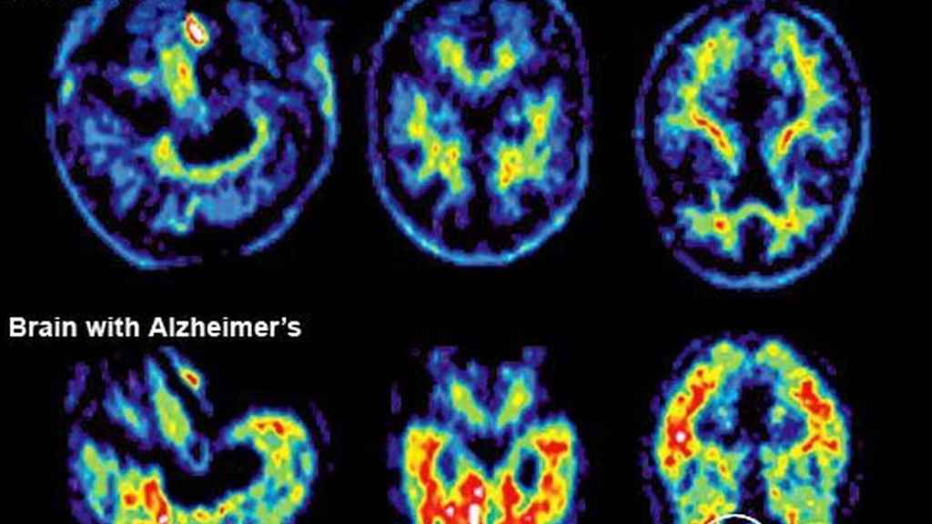 Imágenes de la resonancia magnética de un enfermo de alzhéimer.