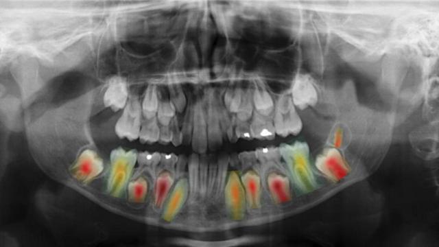 Imagen de una radiografía dental.