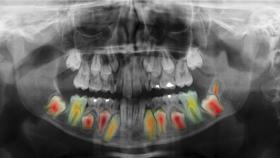Imagen de una radiografía dental.