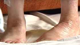 Los pies de un niño con 'piel de mariposa'.