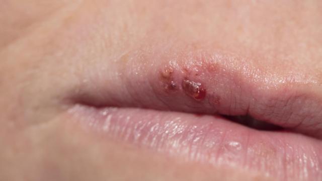 Un herpes labial.