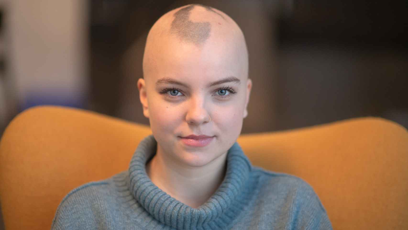 ¿Qué tipos de alopecia son habituales en mujeres?