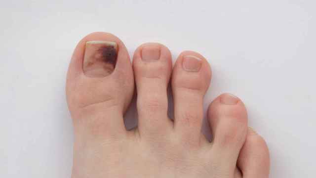 ¿Por qué hay personas con las uñas de los pies negras después de las vacaciones de Semana Santa?