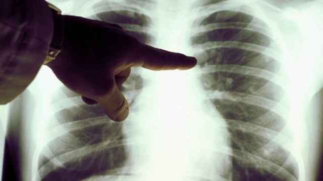El cáncer más frecuente entre los tumores estudiados ha sido el de pulmón