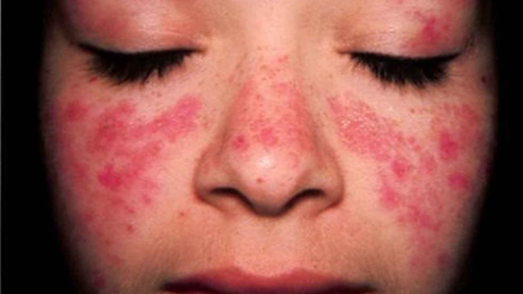 Imagen de archivo de una niña con lupus.