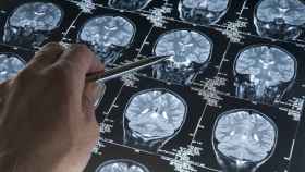 Un sanitario revisa una prueba de imagen del cerebro.