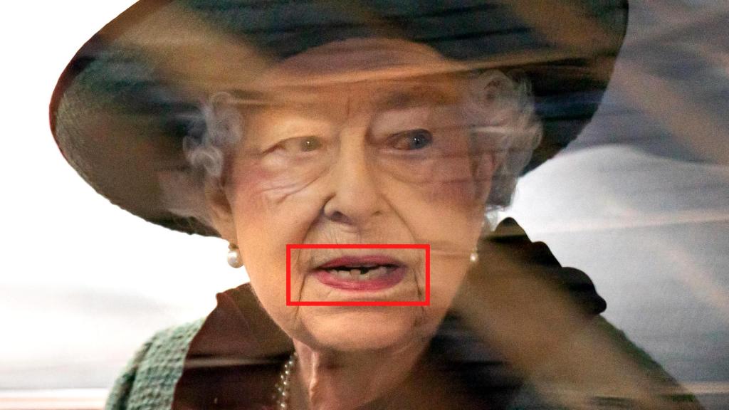 La Reina muestra un apiñamiento severo en la zona inferior de su dentadura.