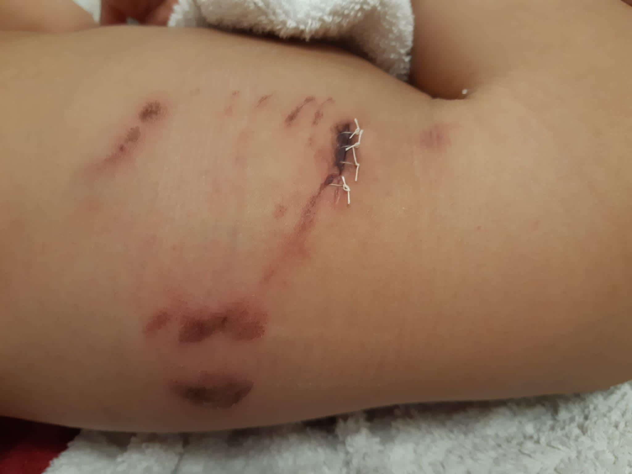 Las heridas del niño tras la mordedura del perro