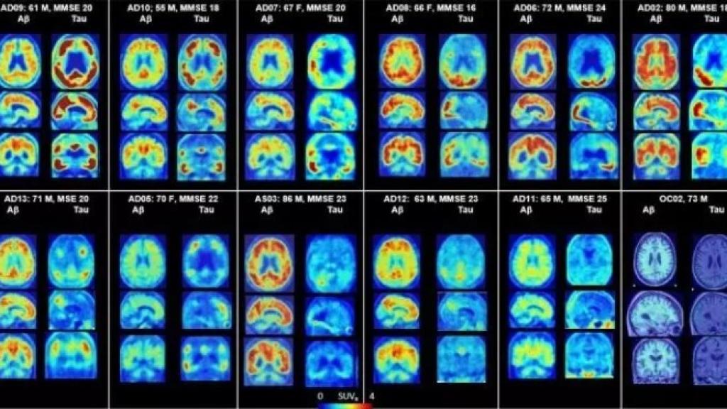 PET del cerebro que muestra placas amiloides y proteínas tau en alzhéimer.
