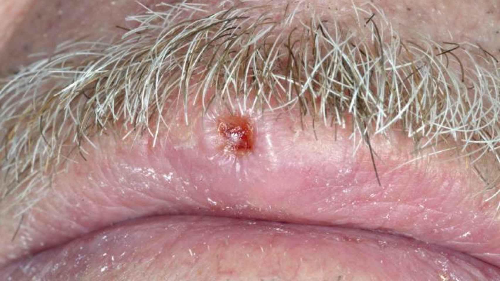 Carcinoma de células escamosas en el labio.