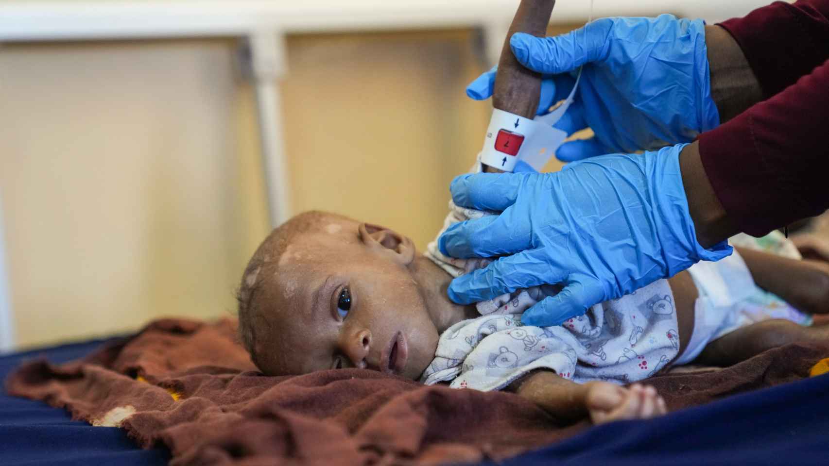 Un niño con malnutrición en un hospital de Mogadiscio, Somalia
