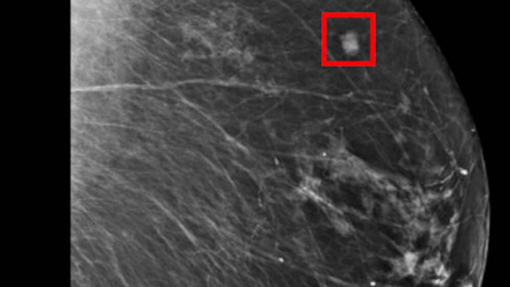 Imágenes de una mamografía de una paciente con cáncer de mama.
