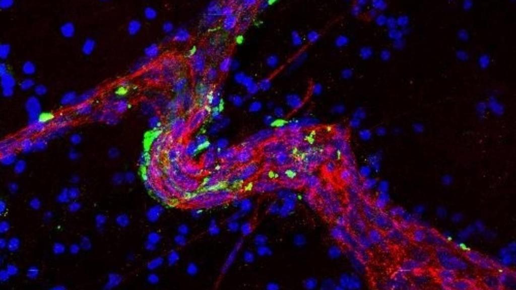 Un gran vaso sanguíneo con células metastásicas cerebrales.