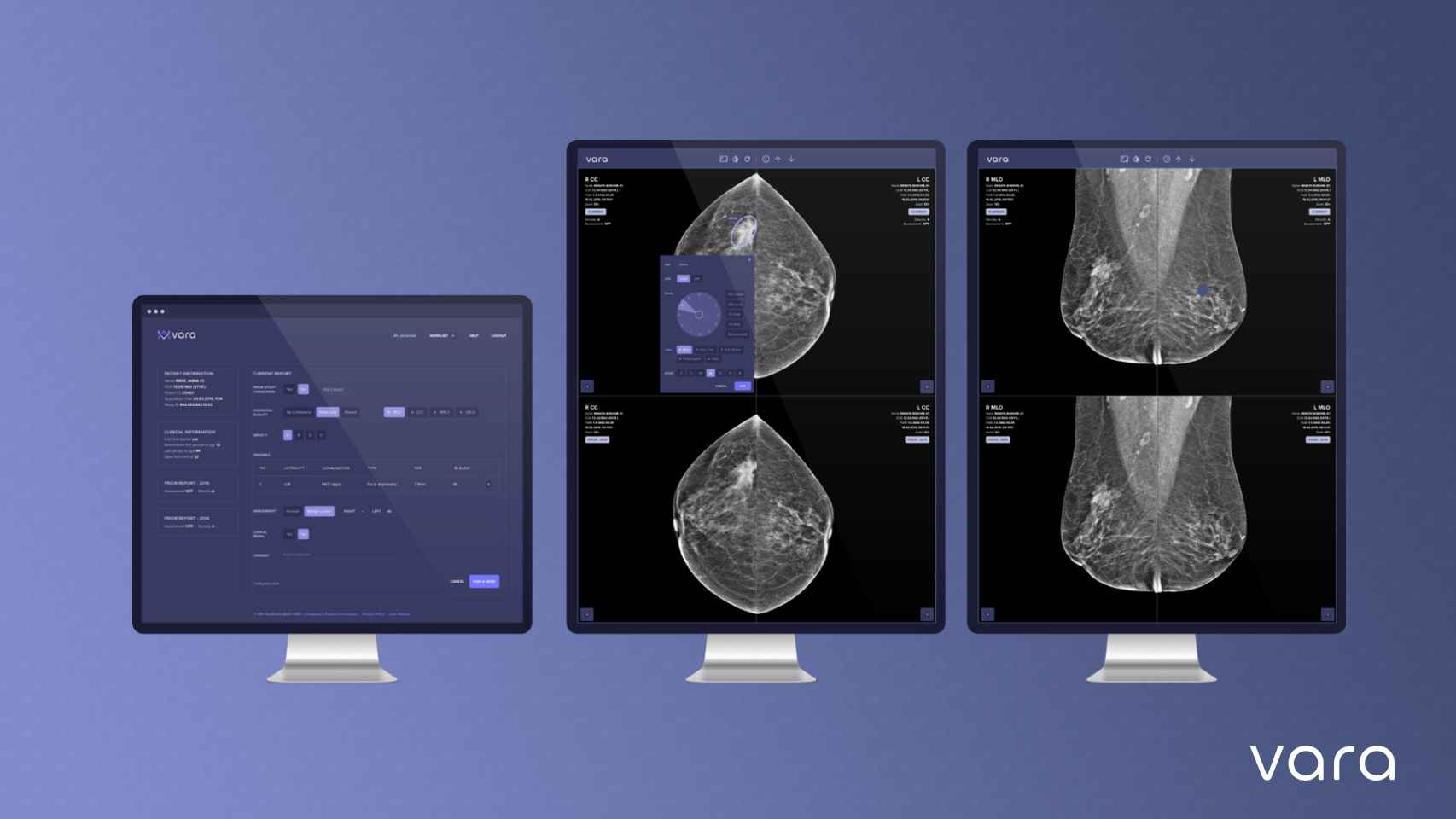 El software de Vara que identifica tumores en las mamografías