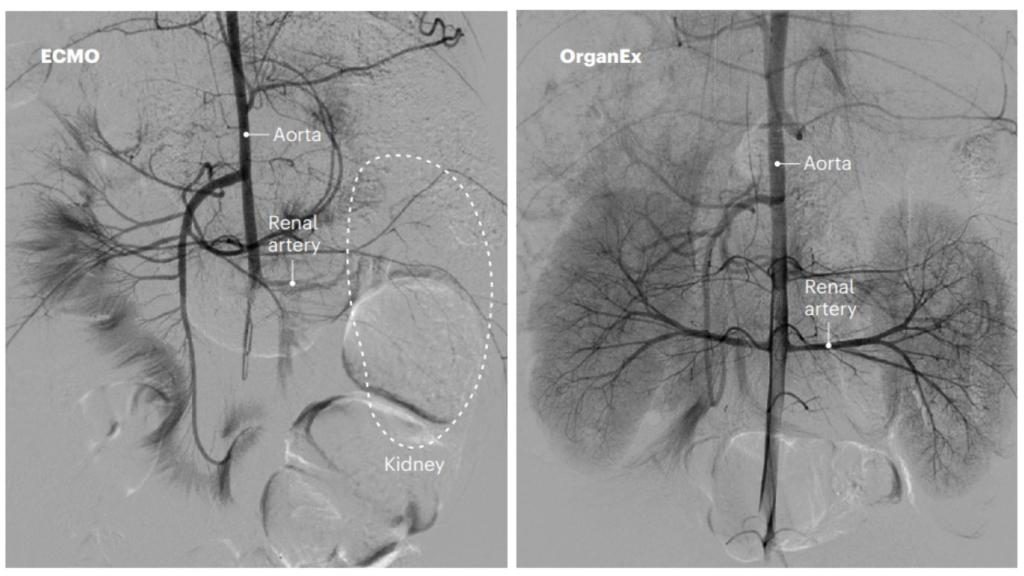 La recuperación postmortem de los riñones de cerdo mediante ECMO (izquierda) y mediante OrganEx (derecha).