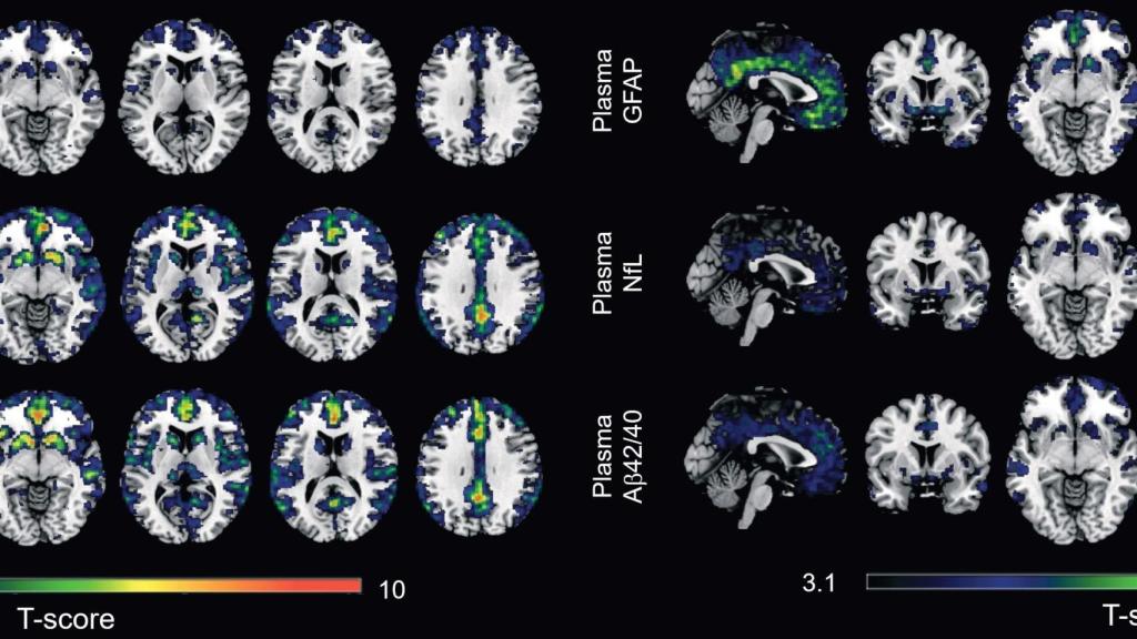 Un estudio identifica dos biomarcadores en sangre para captar los primeros indicios del Alzheimer.