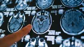 Un sanitario señala una prueba de imagen de un cerebro.