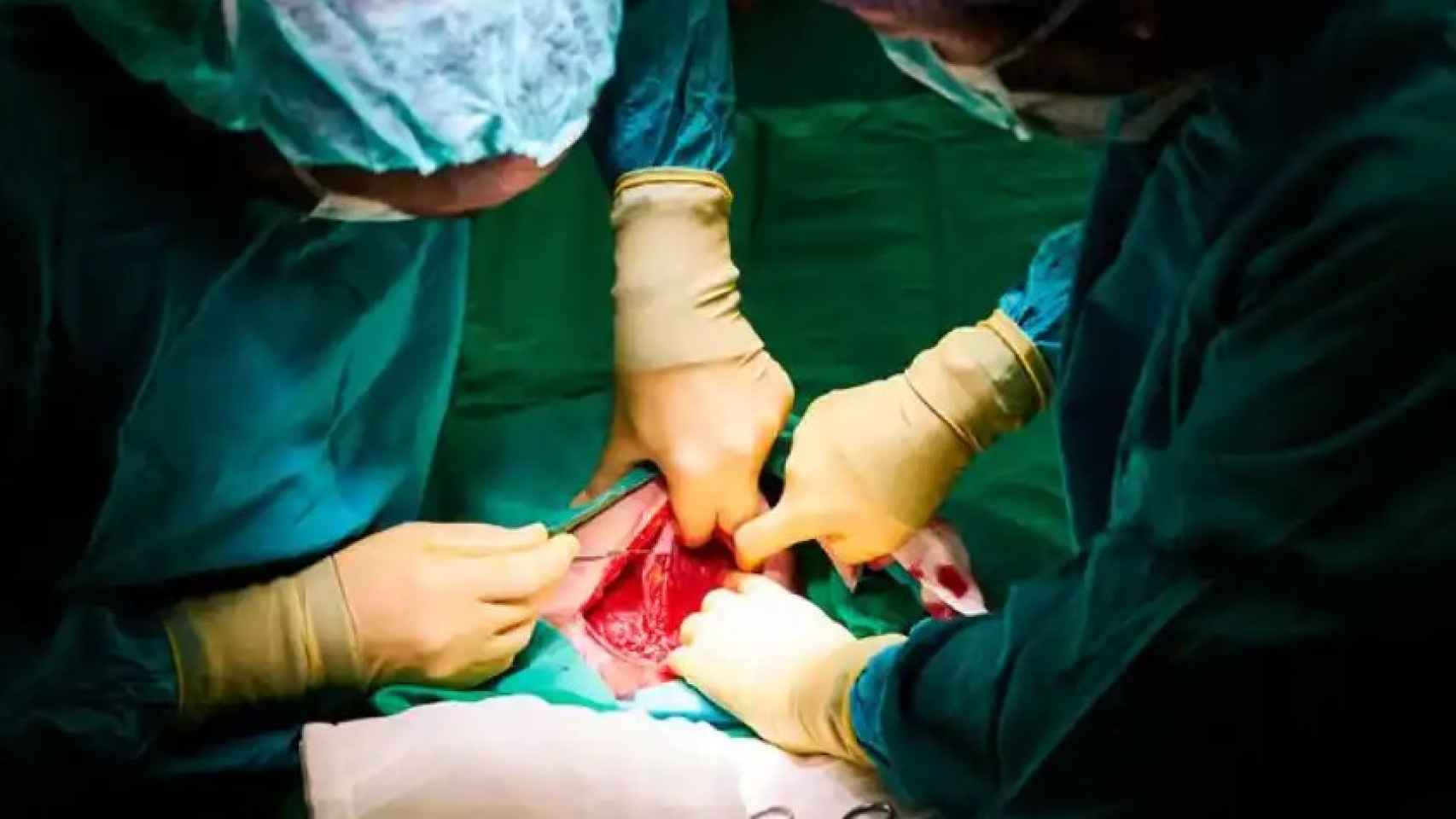 Una cirugía para introducir un implante de silicona para aumentar el pecho publicada en Crónica Global.